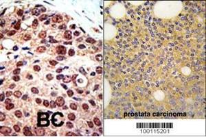 Formalin-fixed and paraffin-embedded human prostata carcinoma tissue reacted with PRMT3 Antibody (C-term) (ABIN387839 and ABIN2843941) , which was peroxidase-conjugated to the secondary antibody, followed by DAB staining. (PRMT3 anticorps  (C-Term))