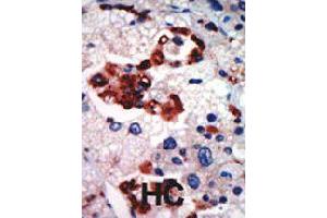 Formalin-fixed and paraffin-embedded human hepatocellular carcinoma tissue reacted with PRKCI polyclonal antibody  , which was peroxidase-conjugated to the secondary antibody, followed by AEC staining . (PKC iota anticorps  (N-Term))