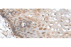 Immunohistochemistry of paraffin-embedded Human esophagus cancer tissue using CHRNA5 Polyclonal Antibody at dilution of 1:50(x200)