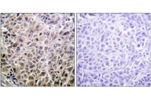 Immunohistochemistry analysis of paraffin-embedded human liver carcinoma tissue, using DAPK1 (Ab-308) Antibody. (DAP Kinase 1 anticorps  (AA 274-323))