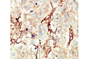 IHC analysis of FFPE human breast carcinoma tissue stained with the FGFR3 antibody (FGFR3 anticorps  (AA 776-806))