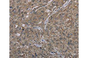 Immunohistochemistry of Human gastric cancer using CLPS Polyclonal Antibody at dilution of 1:40 (CLPS anticorps)