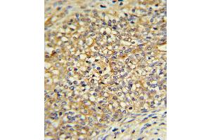 UDB17 Antibody IHC analysis in formalin fixed and paraffin embedded human Prostate carcinoma followed by peroxidase conjugation of the secondary antibody and DAB staining. (UGT2B17 anticorps  (AA 119-147))
