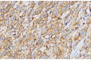 Immunohistochemistry of paraffin-embedded Human esophageal squamous carcinomas using SERPINB2 Polycloanl Antibody at dilution of 1:200