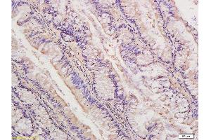 Formalin-fixed and paraffin embedded human colon cancer labeled with Anti-IDE Polyclonal Antibody, Unconjugated  at 1:300, followed by conjugation to the secondary antibody and DAB staining