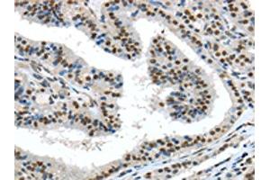 The image on the left is immunohistochemistry of paraffin-embedded Human thyroid cancer tissue using ABIN7131359(TKT Antibody) at dilution 1/30, on the right is treated with fusion protein. (TKT anticorps)