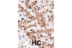 Formalin-fixed and paraffin-embedded human hepatocellular carcinoma tissue reacted with KCNIP3 polyclonal antibody  , which was peroxidase-conjugated to the secondary antibody, followed by AEC staining. (DREAM anticorps  (N-Term))