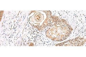 Immunohistochemistry of paraffin-embedded Human esophagus cancer tissue using EWSR1 Polyclonal Antibody at dilution of 1:70(x200)