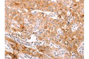 The image on the left is immunohistochemistry of paraffin-embedded Human lung cancer tissue using ABIN7189783(ALPPL2 Antibody) at dilution 1/20, on the right is treated with synthetic peptide. (ALPPL2 anticorps)
