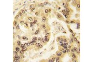 IHC analysis of FFPE human lung carcinoma tissue stained with p53 antibody