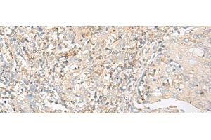 Immunohistochemistry of paraffin-embedded Human cervical cancer tissue using GLIS1 Polyclonal Antibody at dilution of 1:50(x200)