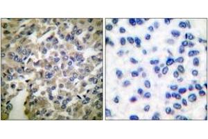 Immunohistochemistry analysis of paraffin-embedded human breast carcinoma tissue, using Synaptotagmin (Ab-309) Antibody. (Synaptotagmin anticorps  (AA 276-325))