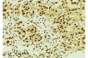 ABIN6276334 at 1/100 staining Human breast cancer tissue by IHC-P. (NME1 anticorps  (C-Term))