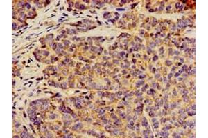 Immunohistochemistry of paraffin-embedded human ovarian cancer using ABIN7144300 at dilution of 1:100