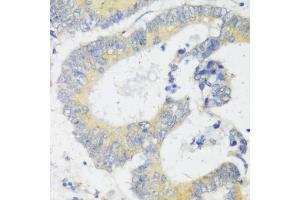 Immunohistochemistry of paraffin-embedded human colon carcinoma using Snail antibody (ABIN6132675, ABIN6148177, ABIN6148180 and ABIN6221190) at dilution of 1:100 (40x lens). (SNAIL anticorps  (C-Term))