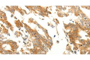 Immunohistochemistry of paraffin-embedded Human gastric cancer using RARRES1 Polyclonal Antibody at dilution of 1:60 (RARRES1 anticorps)