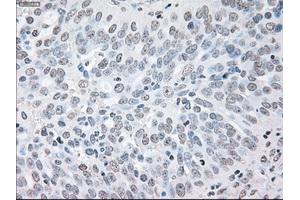 Immunohistochemical staining of paraffin-embedded Adenocarcinoma of colon tissue using anti-BRAFmouse monoclonal antibody. (BRAF anticorps)