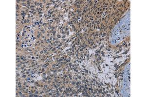 Immunohistochemistry of Human cervical cancer using CDC16 Polyclonal Antibody at dilution of 1:50 (CDC16 anticorps)