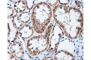Immunohistochemical staining of paraffin-embedded Carcinoma of prostate tissue using anti-APP mouse monoclonal antibody. (APP anticorps)