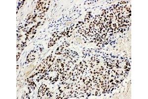 IHC-P: MCM3 antibody testing of human lung cancer tissue (MCM3 anticorps  (N-Term))