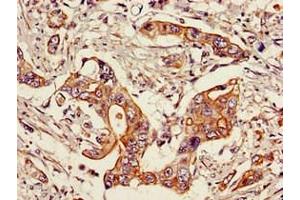 Immunohistochemistry of paraffin-embedded human pancreatic cancer using ABIN7169690 at dilution of 1:100