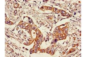 Immunohistochemistry of paraffin-embedded human pancreatic cancer using ABIN7169690 at dilution of 1:100 (STAT6 anticorps  (AA 1-319))
