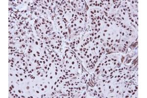 IHC-P Image Immunohistochemical analysis of paraffin-embedded Cal27 Xenograft, using Apoptosis-enhancing nuclease, antibody at 1:100 dilution. (AEN anticorps  (C-Term))