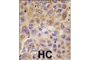 Formalin-fixed and paraffin-embedded human hepatocarcinoma tissue reacted with PFKFB1 antibody (Center), which was peroxidase-conjugated to the secondary antibody, followed by DAB staining. (PFKFB1 anticorps  (AA 259-289))