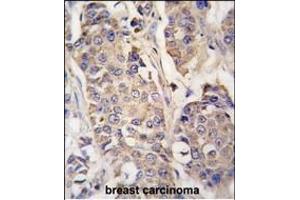 Formalin-fixed and paraffin-embedded human breast carcinoma tissue reacted with ACO2 antibody (Center) (ABIN391809 and ABIN2841660) , which was peroxidase-conjugated to the secondary antibody, followed by DAB staining.