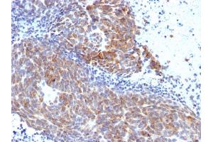 Formalin-fixed, paraffin-embedded human Melanoma stained with Topo I, MT Mouse Monoclonal Antibody (TOP1MT/568). (TOP1MT anticorps)