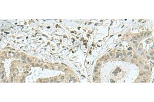 Immunohistochemistry of paraffin-embedded Human thyroid cancer tissue using THTPA Polyclonal Antibody at dilution of 1:70(x200)
