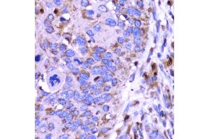 Immunohistochemistry of paraffin-embedded human esophageal cancer using SPARC antibody (ABIN5970787) at dilution of 1/100 (40x lens). (SPARC anticorps)