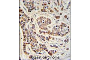 ATHL1 Antibody IHC analysis in formalin fixed and paraffin embedded human breast carcinoma followed by peroxidase conjugation of the secondary antibody and DAB staining. (ATHL1 anticorps  (C-Term))