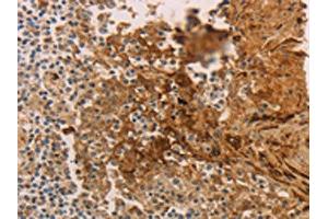 The image on the left is immunohistochemistry of paraffin-embedded Human tonsil tissue using ABIN7189672(ADCYAP1R1 Antibody) at dilution 1/70, on the right is treated with synthetic peptide.