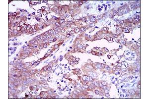 Immunohistochemical analysis of paraffin-embedded endometrial cancer tissues using EGFR mouse mAb with DAB staining.