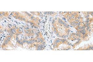 Immunohistochemistry of paraffin-embedded Human lung cancer tissue using RPS16 Polyclonal Antibody at dilution of 1:60(x200) (RPS16 anticorps)