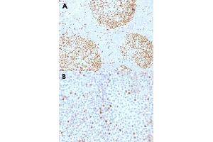 Immunohistochemical staining (Formalin-fixed paraffin-embedded sections) of human tonsil (A) and human bladder carcinoma (B) with TOP2A monoclonal antibody, clone TOP2A/1361 . (Topoisomerase II alpha anticorps  (AA 1352-1493))
