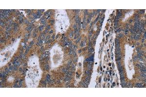 Immunohistochemistry of paraffin-embedded Human colon cancer using GSTA3 Polyclonal Antibody at dilution of 1:30 (GSTA3 anticorps)