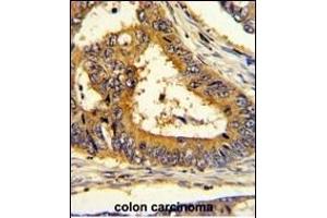 Formalin-fixed and paraffin-embedded human colon carcinoma with SC Antibody (Center), which was peroxidase-conjugated to the secondary antibody, followed by DAB staining.