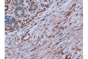 Detection of VIM in Human Breast cancer Tissue using Monoclonal Antibody to Vimentin (VIM)