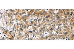 Immunohistochemistry of paraffin-embedded Human liver cancer tissue using PLIN4 Polyclonal Antibody at dilution of 1:50(x200)