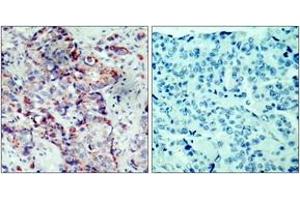 Immunohistochemistry analysis of paraffin-embedded human breast carcinoma, using SEK1/MKK4 (Phospho-Ser80) Antibody.