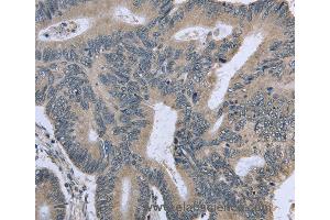 Immunohistochemistry of Human cervical cancer using BMX Polyclonal Antibody at dilution of 1:30 (BMX anticorps)