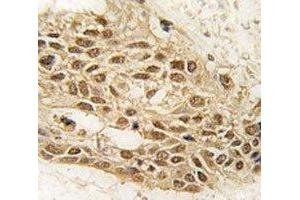 IHC analysis Dnmt3a antibody and human lung carcinoma tissue