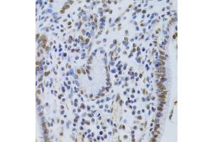 Immunohistochemistry of paraffin-embedded human gastric cancer using XRCC5 Antibody.