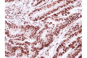 IHC-P Image Immunohistochemical analysis of paraffin-embedded human colon carcinoma, using SNRPD2, antibody at 1:250 dilution. (SNRPD2 anticorps)