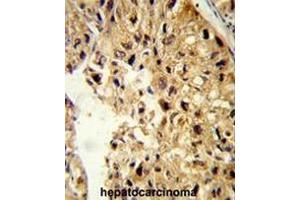 Formalin-fixed and paraffin-embedded human hepatocarcinoma reacted with PCBD1 Antibody (Center), which was peroxidase-conjugated to the secondary antibody, followed by DAB staining. (PCBD1 anticorps  (Middle Region))