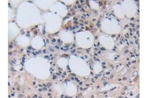 Detection of NUP50 in Human Skin cancer Tissue using Polyclonal Antibody to Nucleoporin 50 kDa (NUP50)