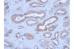 Formalin-fixed, paraffin-embedded human Prostate stained with Pan-Cytokeratin Mouse Monoclonal Antibody (PCK/3150). (KRT anticorps)