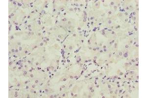 Immunohistochemistry of paraffin-embedded human gastric cancer using ABIN7158154 at dilution of 1:100 (LRRC2 anticorps  (AA 1-184))